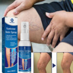 Varicose Vein Spray Relief Veins Minimize Varicose Veins and Spider Veins