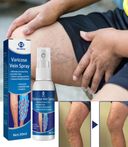 Varicose Vein Spray Relief Veins Minimize Varicose Veins and Spider Veins