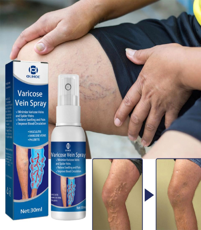 Varicose Vein Spray Relief Veins Minimize Varicose Veins and Spider Veins